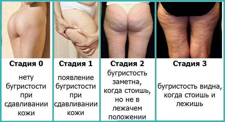 Как избавится от целлюлита